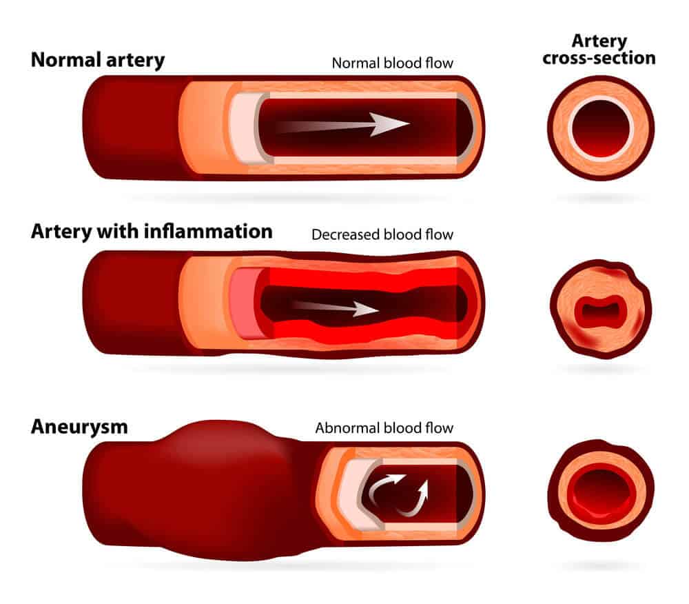 Symptoms of Carotid Artery Disease | Specialist Vein Health