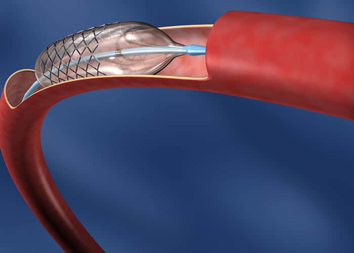Arterial Treatments