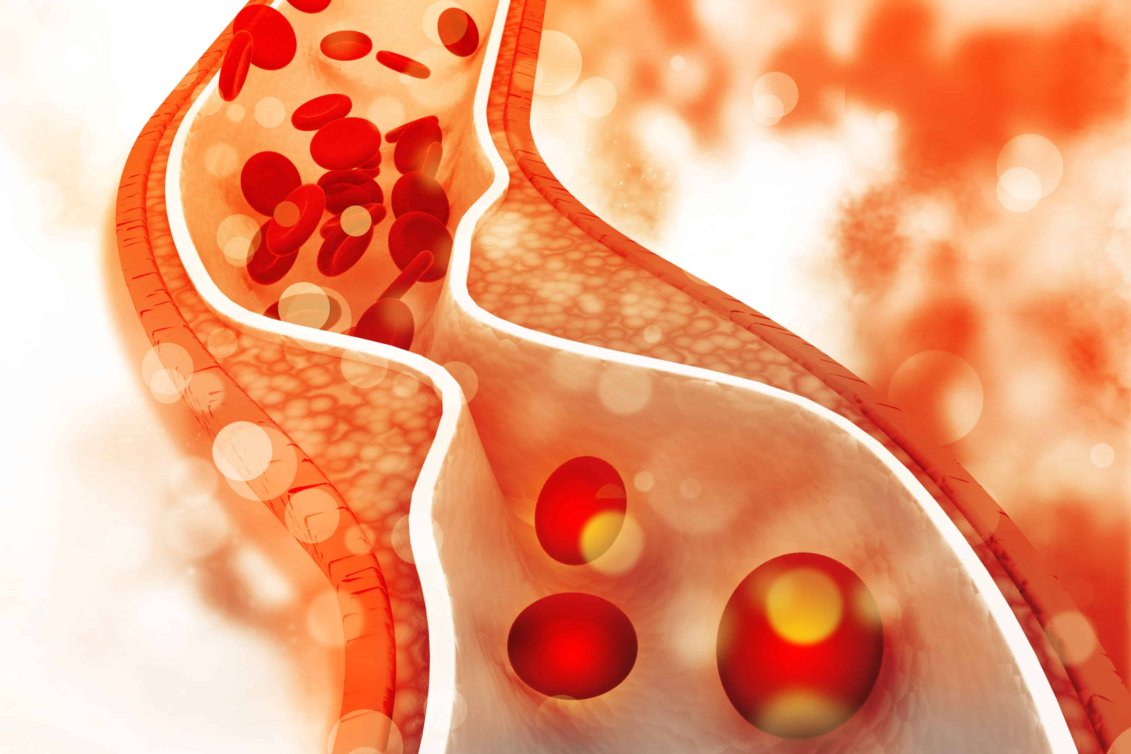 What Is Arteriosclerosis Atherosclerosis Specialist Vein Health