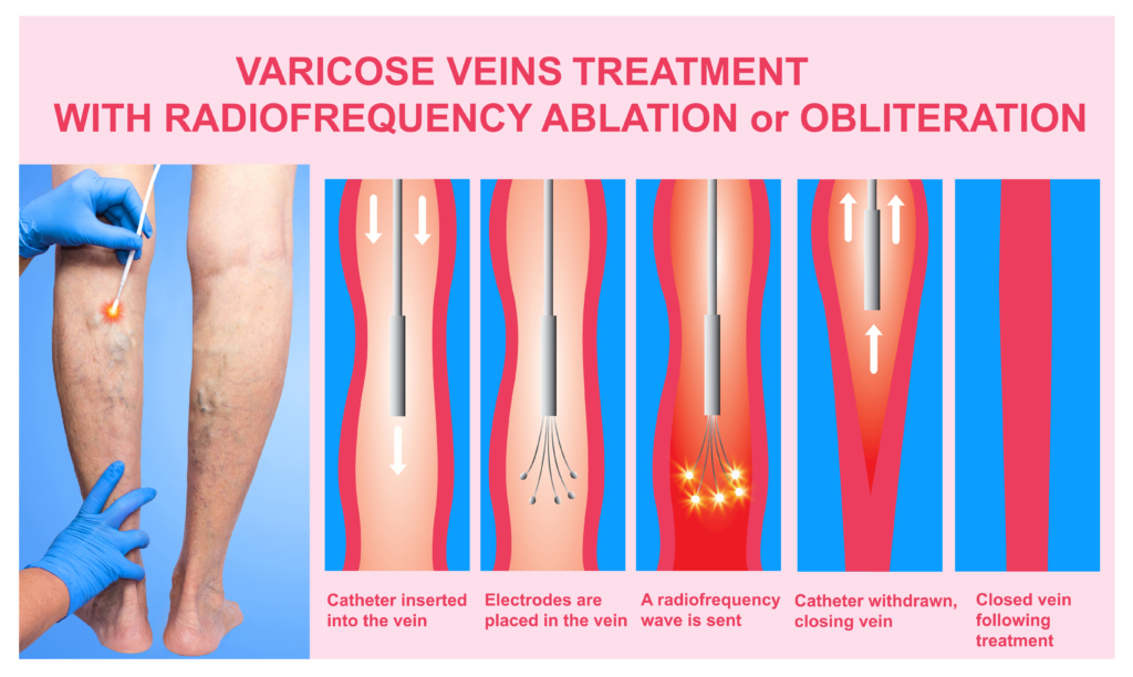 Varicose Veins - Causes, Symptoms, Removal & Treatments - Auckland